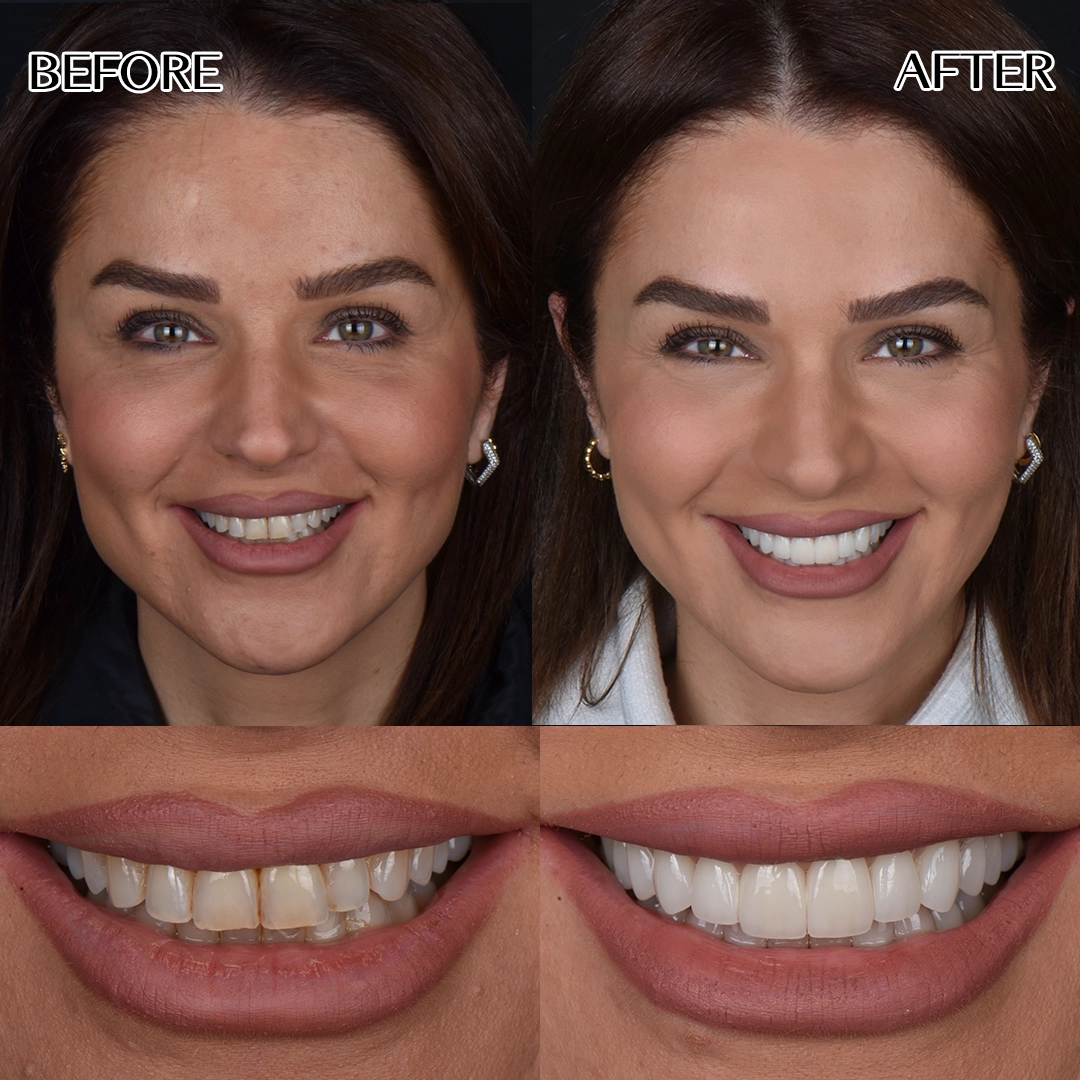 Smile design in Istanbul