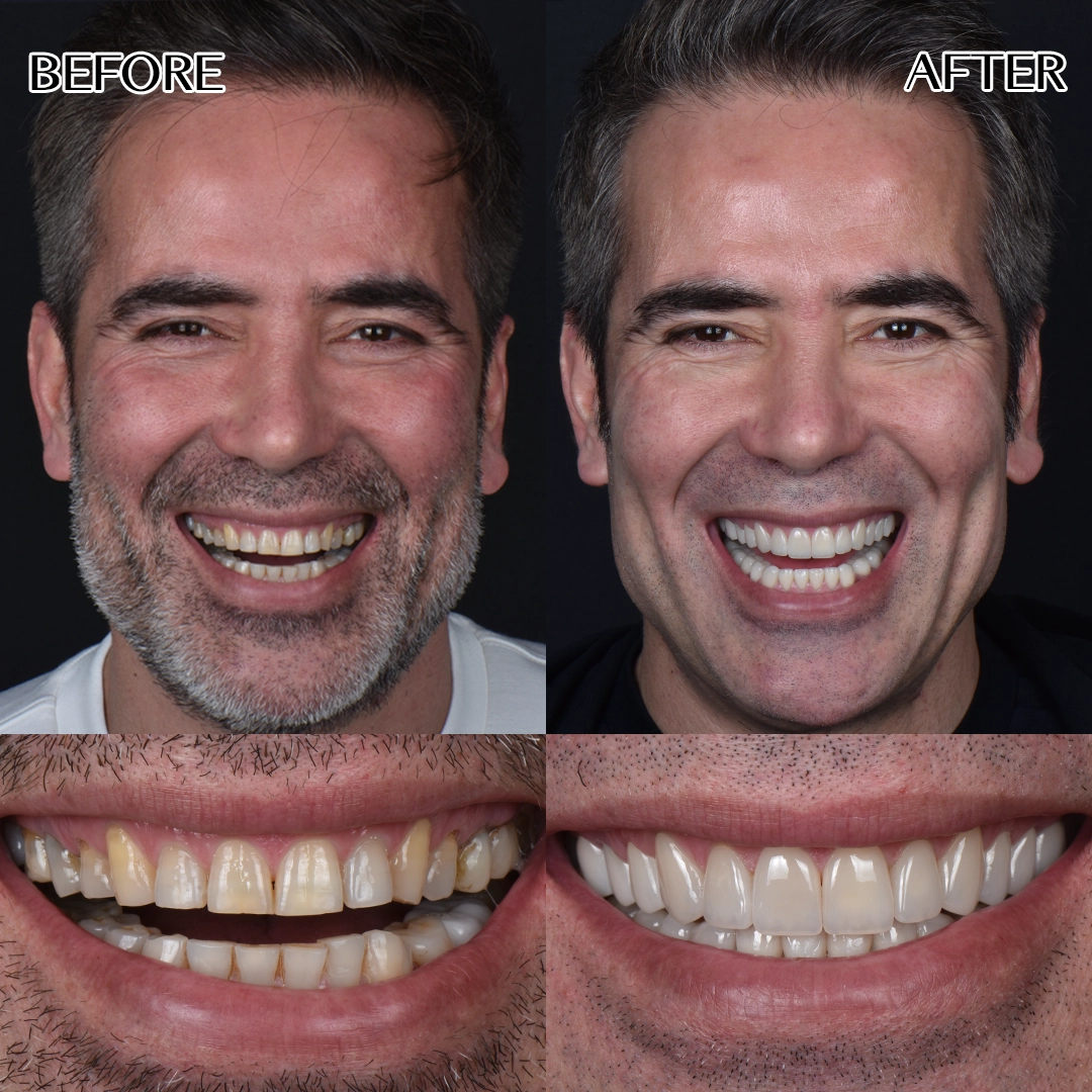Full dental veneers Turkey