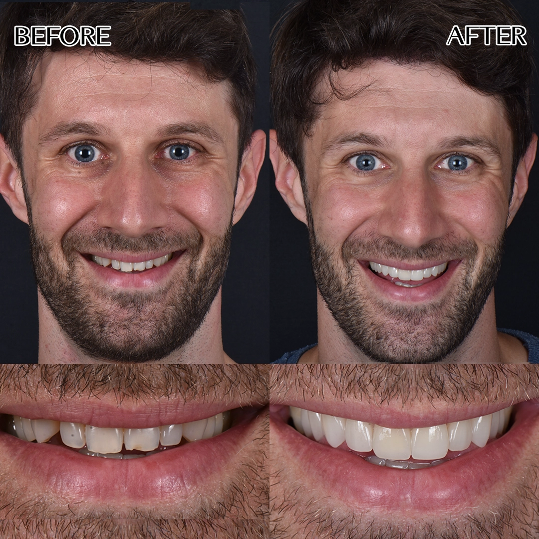 Dental veneers Turkey