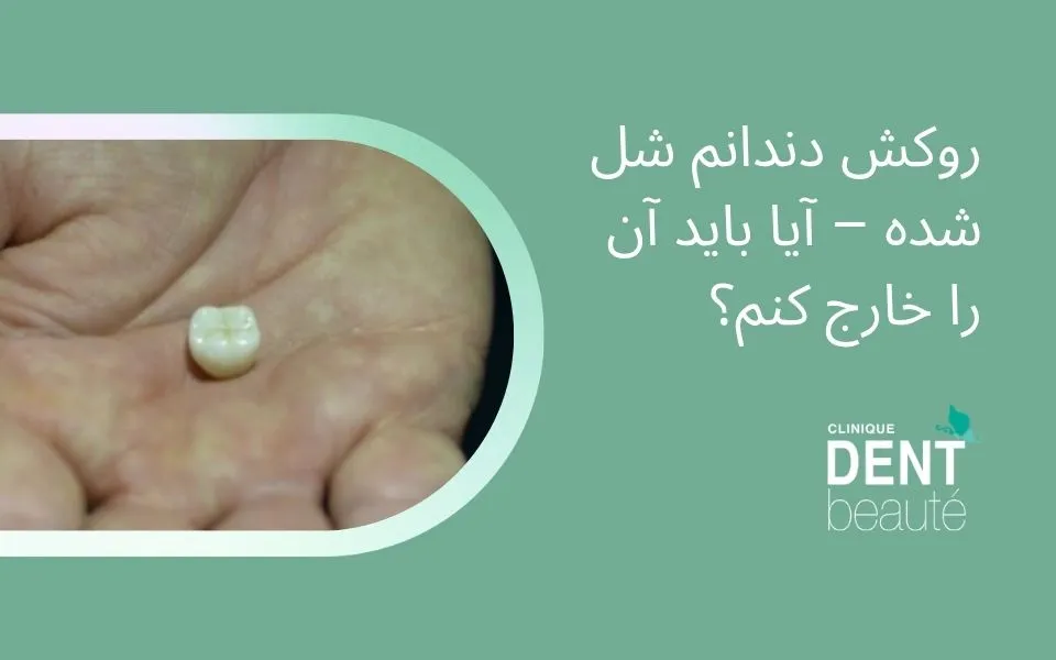 روکش دندانم شل شده – آیا باید آن را خارج کنم؟ روکش دندانم شل شده