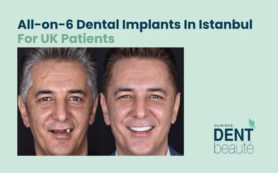 All-on-six dental implants in Istanbul