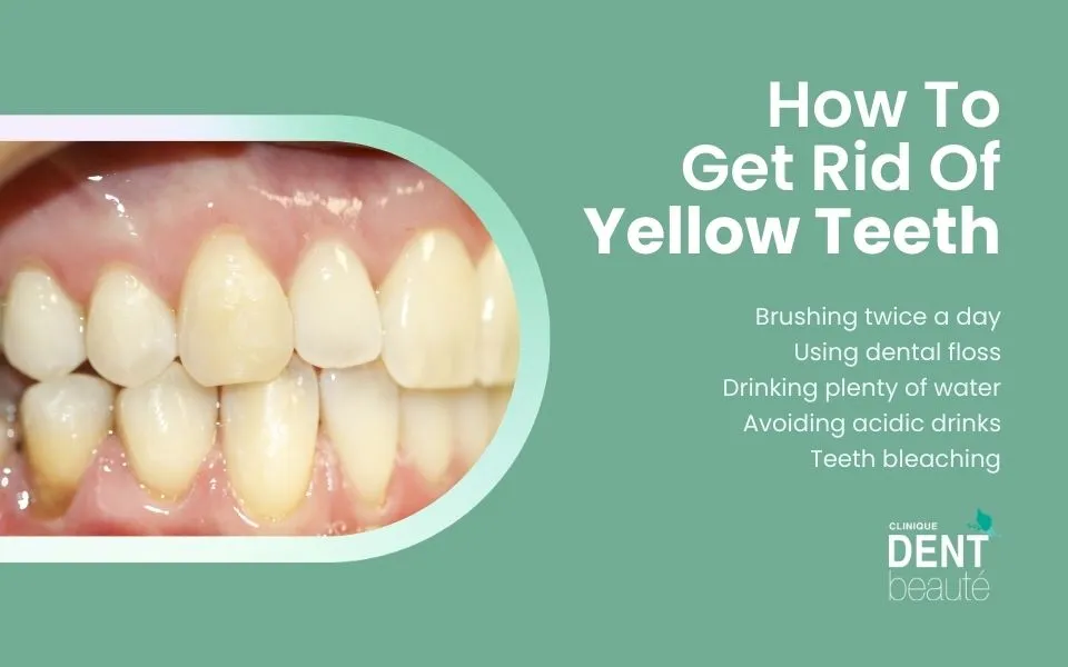 How to get rid of yellow teeth How to get rid of yellow teeth