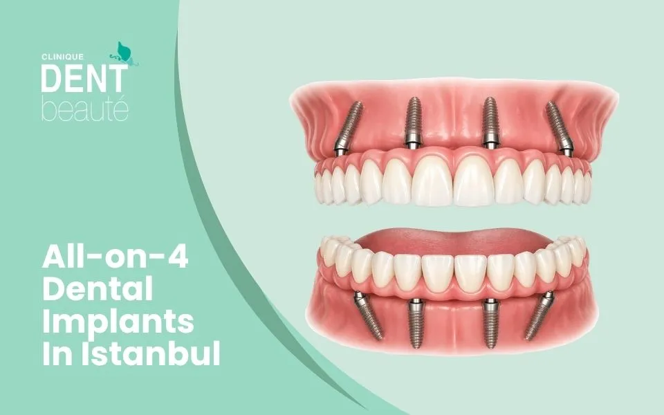 All-on-4 dental implants in Istanbul