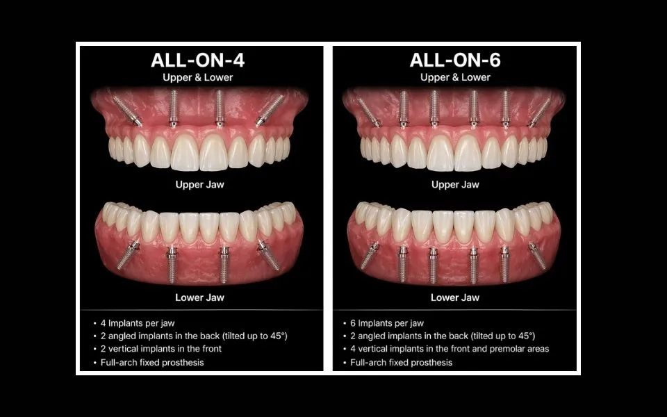 Istanbul All-on-4 vs All-on-6