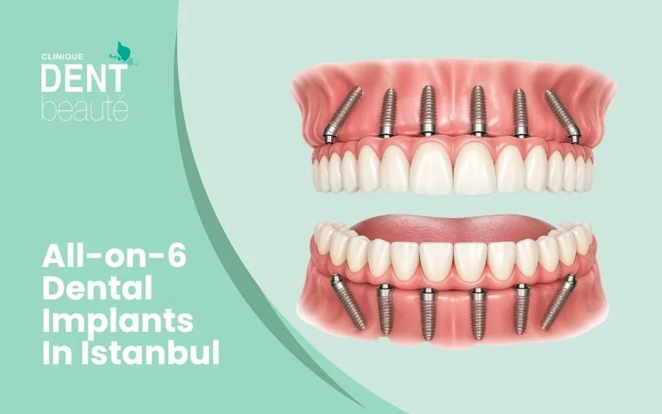 All-on-6 dental implants in Istanbul
