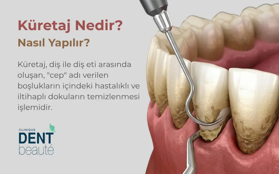 Küretaj Nedir, Nasıl Yapılır?