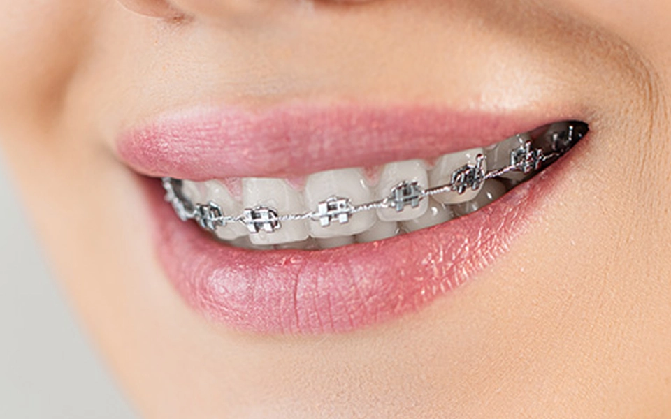 Ortodonti Tedavisi Ortodonti Tedavisi İstanbul